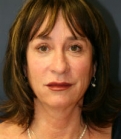 Feel Beautiful - Facelift San Diego Case 20 - Before Photo